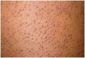 此症乃由于毛囊皮脂腺管之开口处有角化现象,形成所谓的"角栓",而硬化