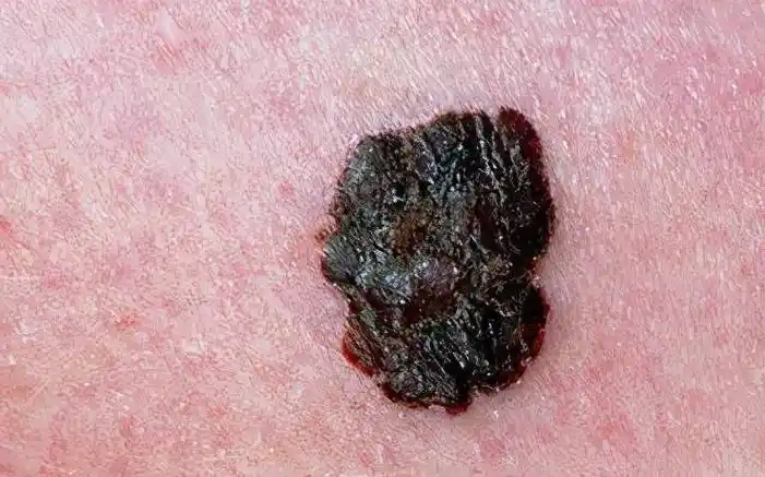 优势!黑色素瘤早期症状图片"千里迢迢"-第1张图片-普贤博客