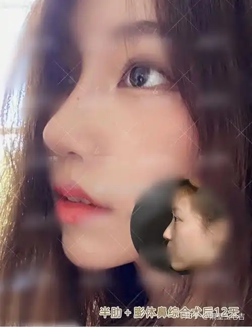 直鼻直鼻微翘还是水滴鼻隆鼻怎么选适合自己的鼻型风格医生功课