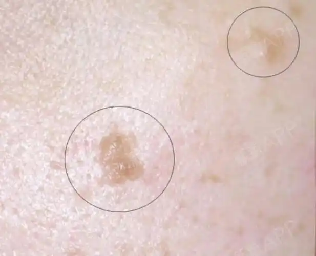 男性假性尖锐湿疣初期图片是怎样的