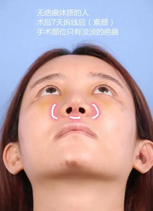 隆鼻术后疤痕增生成因及应对方法