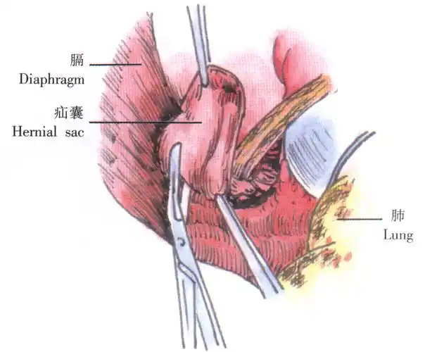 p data-id="gnbhpoton7">食管裂孔疝修补术是用于治疗食管疾病的手术