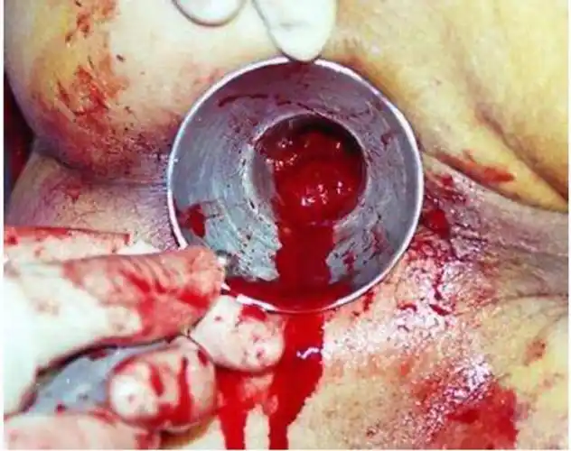 痔疮前期症状图片