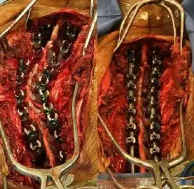 脊柱侧弯手术前后对比图