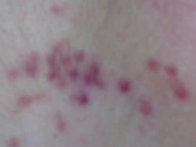 我的胸口上出现了一些红色的斑点(如图),没有突起,不疼不痒,我想知道