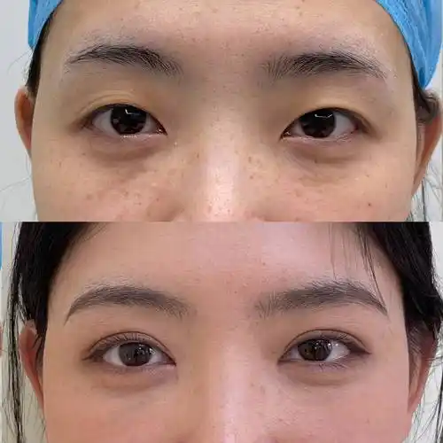 解析好看双眼皮美学标准 整形医生田鑫