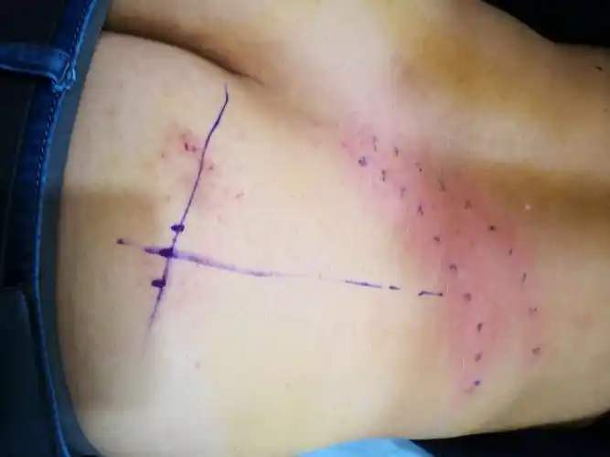 腰大肌外缘线与骶管裂孔横线交叉的位置是闭孔所在,认识它,避开它