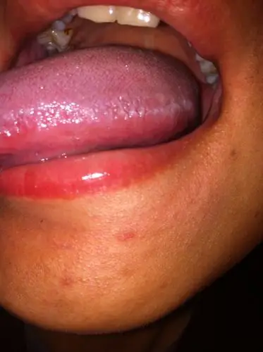 舌头两侧.三年前高位.