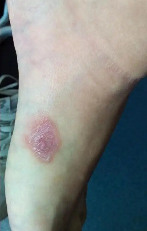 一期梅毒初期生殖器图片