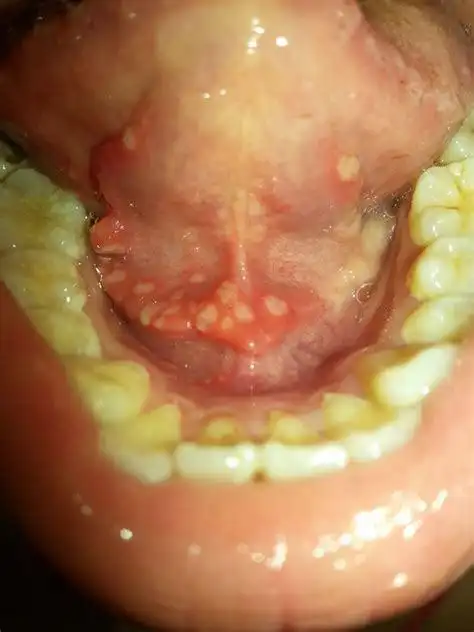 三岁儿子舌头长满水泡,婆婆说是上火,医生检查后,丈夫赶走婆婆