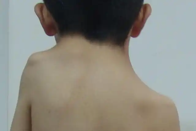 孩子肩膀一高一低,竟然不是脊柱侧弯,还有更严重的问题!