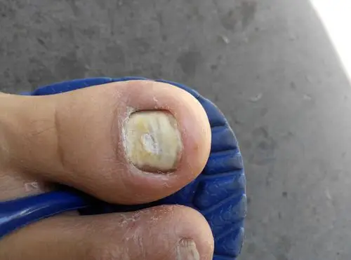 这脚趾头得了什么病?还是缺少微量元素?看图 还有就是怎么治.