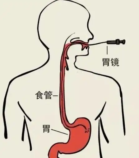 咽炎和食道癌,到底如何区分?听专家讲解!_时候_症状_食管