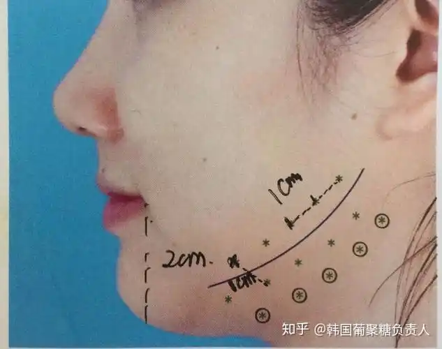 下颌缘紧致注射点位(如上图)年纪偏大或皮肤较为松弛,瘦脸后面部支撑