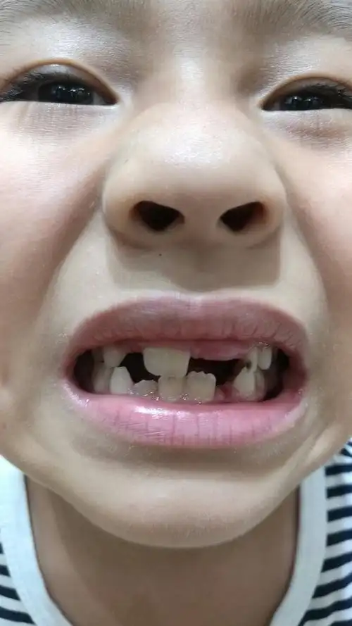 小孩门牙长了一个另一个没长怎么回事