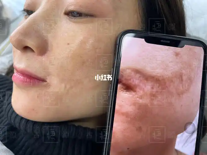 脸部烫伤疤痕对比