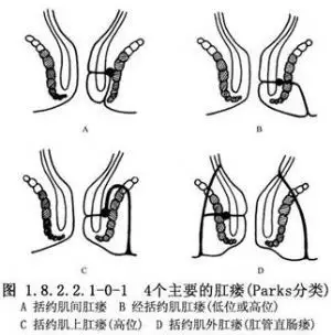 挂线疗法用于肛瘘的手术治疗.