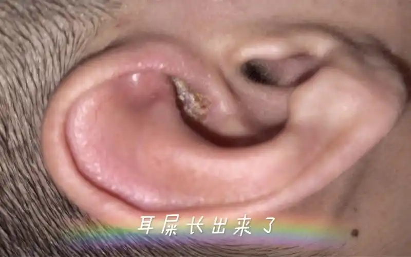 给小哥哥掏老是会结痂的耳朵没想到耳屎都长出来了