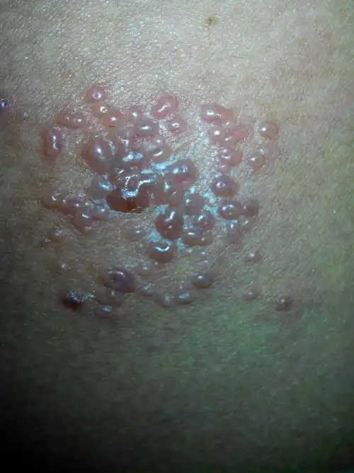 屁股上长泡,不痒,周围泛红,是什么病?