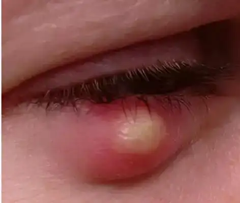 长针眼的症状图片35