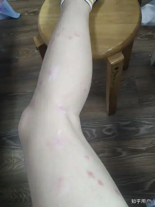 被蚊子咬了五十个包,如何快速消肿? - 知乎