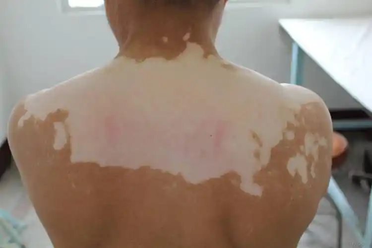 长春肤康医院浅谈:身上长白斑一定是白癜风吗?白癜风该如何辨认?_部位