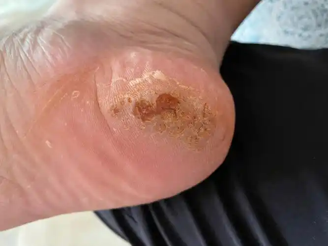 跖疣治疗(第16天)