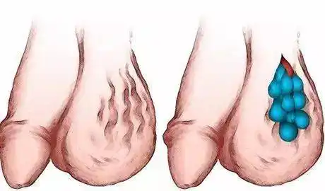 引起睾丸萎缩 :精索静脉曲张时,精索内的静脉变得太长太粗,超过正常