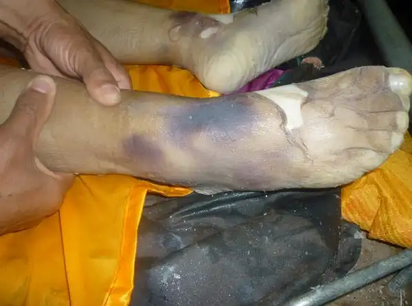 黄凯,陈建雷是如此做"鉴定"的:他们连尸斑的颜色都敢公然歪曲,只要不