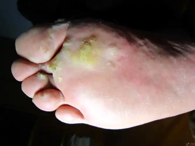 【求助】急求:多发足底跖疣新增病灶(附图)