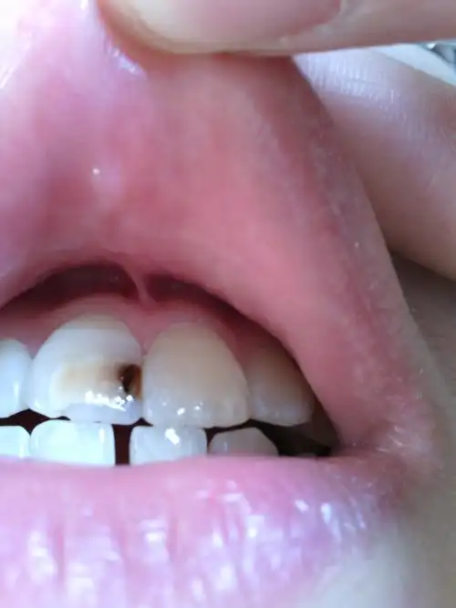 请问这样的蛀牙应该怎样修补比较好?可以不做烤瓷牙吗?