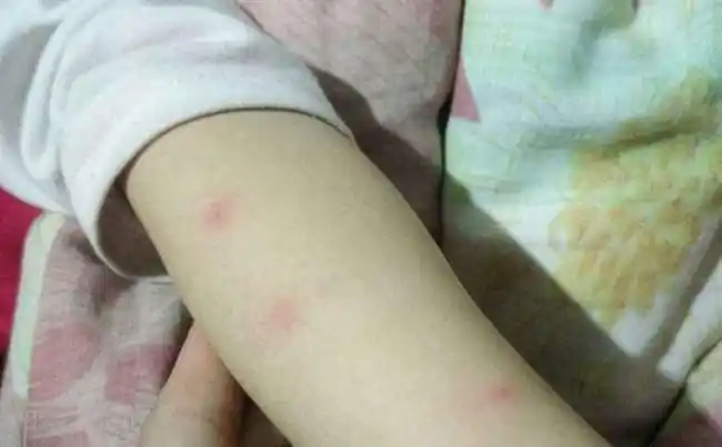 春天来了宝宝皮肤又痛又痒宝妈注意以下几点和皮肤过敏说拜拜