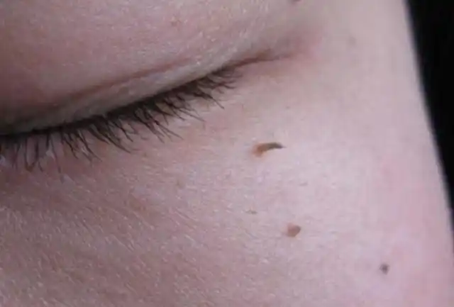 孕妇如有丝状疣会不会影响肚里的宝宝?