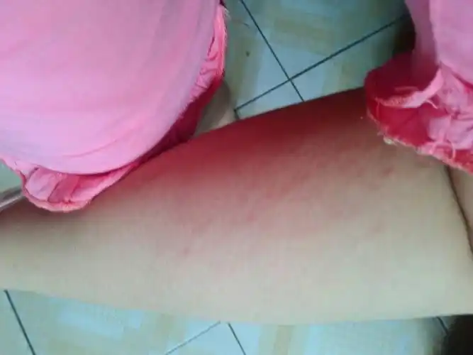 我今年15,大概11岁左右小腿后面长了一条条红色的条纹,那是什么?