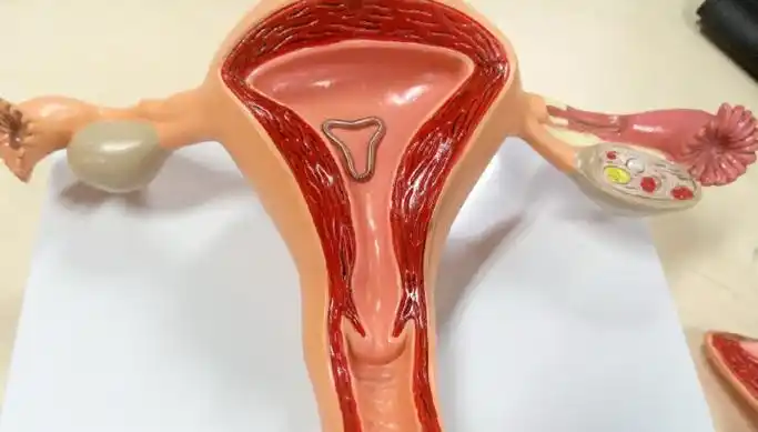 避孕环是什么(抑制环是啥)-第19张图片