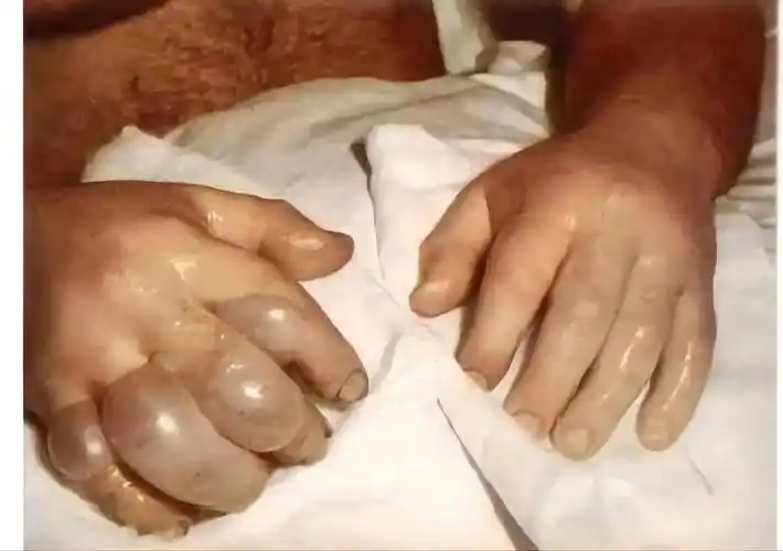 徒手掰开原子弹,他的身体溃烂成一具"活尸"_哈里_路易斯·斯洛廷_辐射