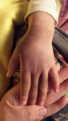 亲 我给你传点图片 我女儿手背有胎记  在北京美迪治疗的 这是没治疗