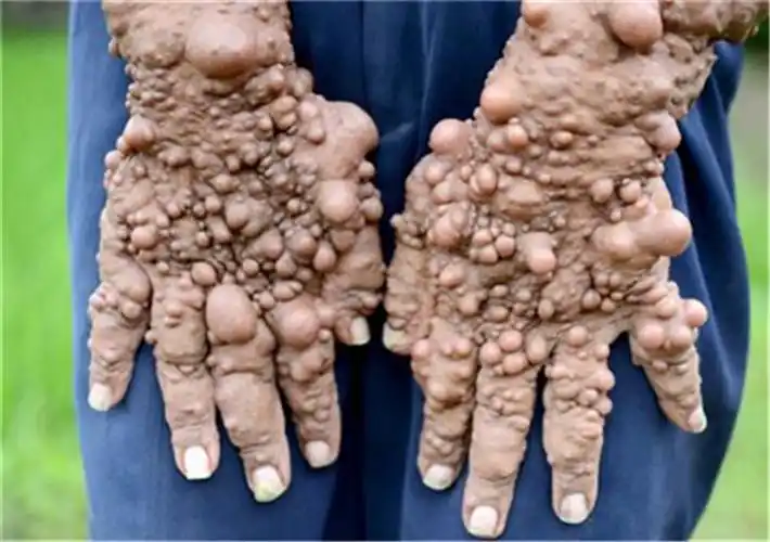 东区肿瘤专家_东区治疗肿瘤哪个专家好_东区治疗肿瘤最好的专家/排行