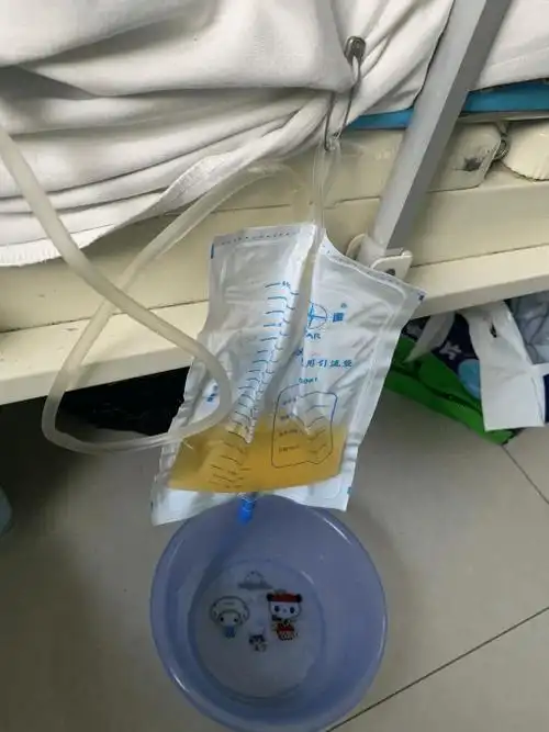 奶奶后来被挂上尿袋.