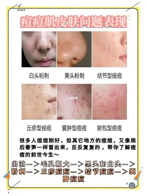 >粉刺—>丘疹痘痘—>结节痘痘—>囊肿痘痘72157215721