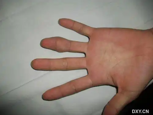 手指肿瘤 - 骨科专业讨论版 -丁香园论坛