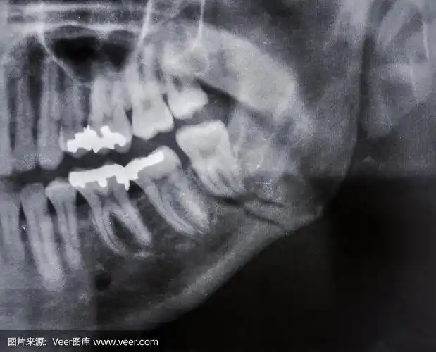 下颌骨骨折,也称为颌骨骨折,是通过下颌骨骨折.