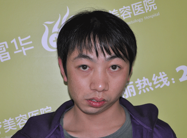 歪脸小伙求"变脸" - 深圳富华医疗美容 - 深圳富华医疗美容
