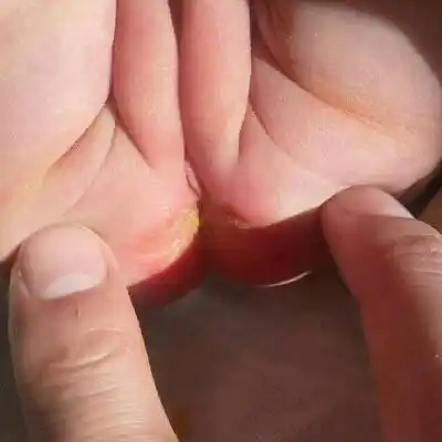 17天婴儿 屁眼发红 破皮 怎麼办?_宝宝树