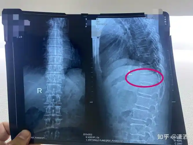 胸椎(t12)压缩性骨折治疗记录 - 知乎