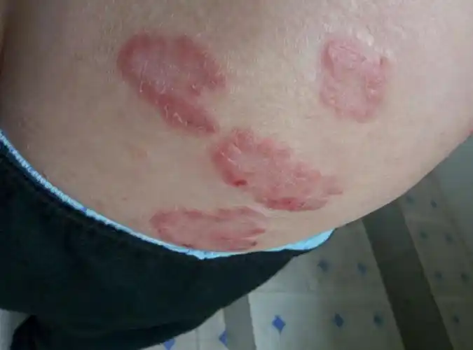 银屑病反复发作十年首先从头部开始蔓延至全身