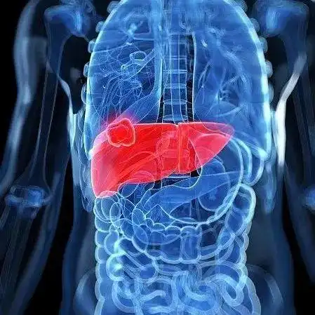 生命垂危却无法承受手术 10小时高级生命支持下完成换肝|肝移植|器官