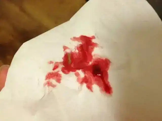 没有痔疮,为什么会便血?医生诊断:别自以为,别忽视直接病因