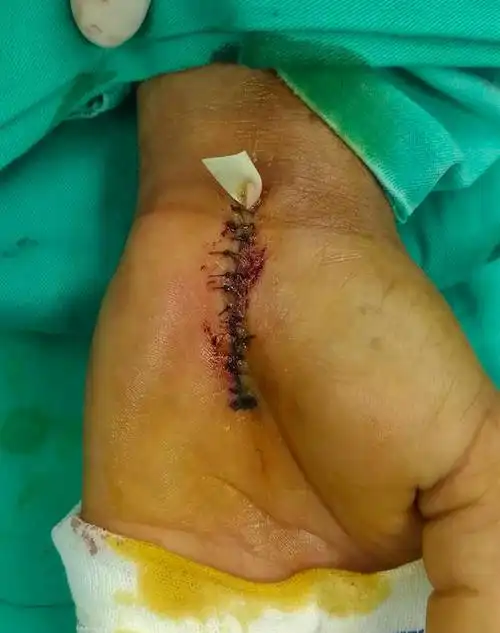 神经卡压综合症手术治疗之腕管综合症