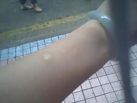 手被香烟烫的,已经脱了层皮,看见白色的肉,周围开始泛红了,不起泡 会